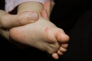 virus-koksaki-u-detej-profilaktika-simptomy-lechenie
