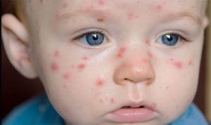 chicken-pox